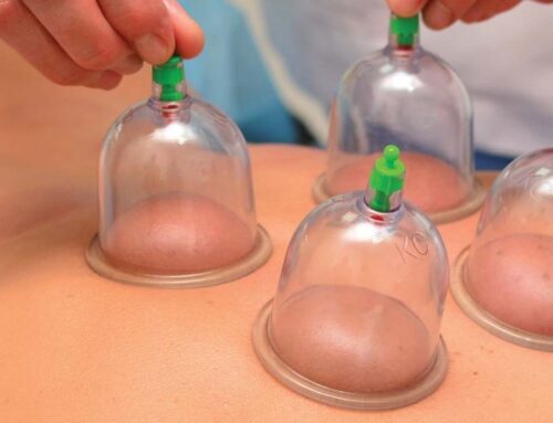 Cupping: ¿Qué nos hacen los moretones?